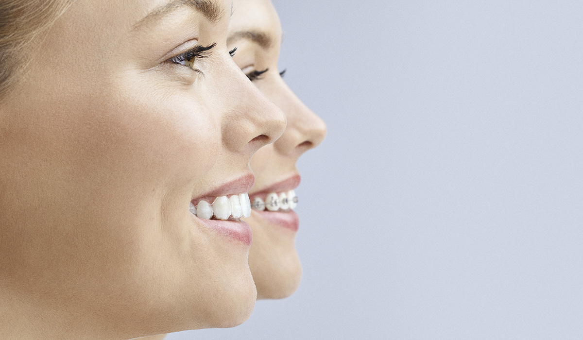Invisalign